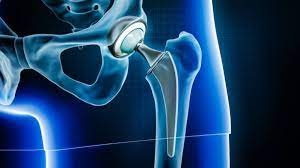 Joint Replacement